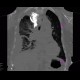 Malposition of central venous line, paravasat, fluidothorax: CT - Computed tomography